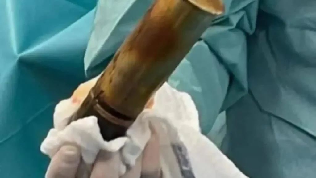 Pacjent z pociskiem artyleryjskim w odbycie. Szpital w Tuluzie w stanie najwyższej gotowości