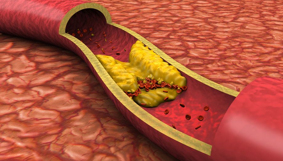 Wysoki cholesterol – przyczyny, porady, symptomy. Jak rozpoznać zagrożenie?