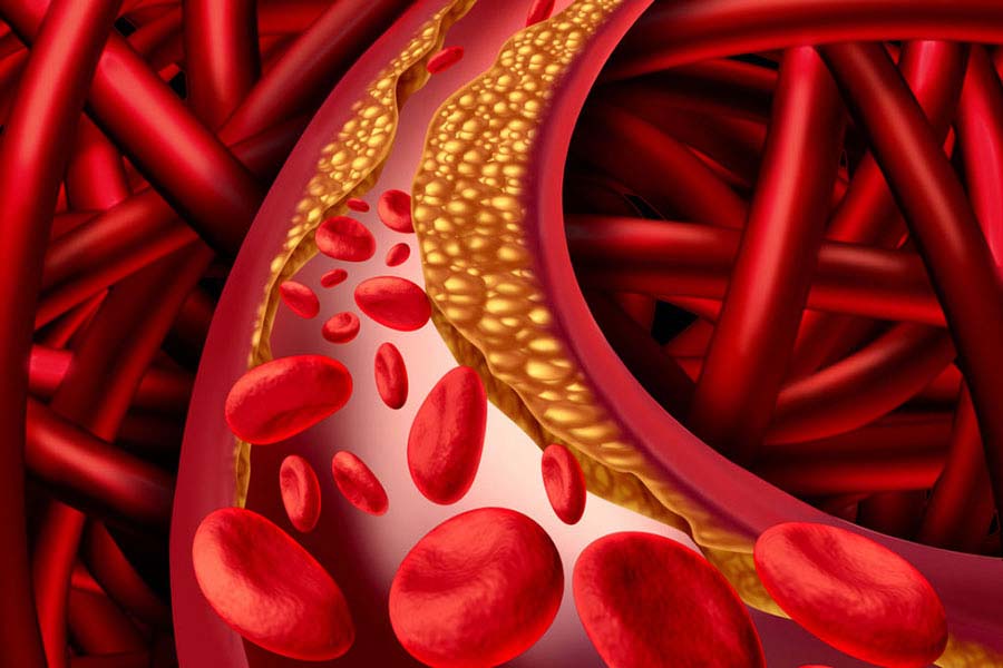 Wysoki cholesterol – przyczyny, porady, symptomy. Jak rozpoznać zagrożenie?