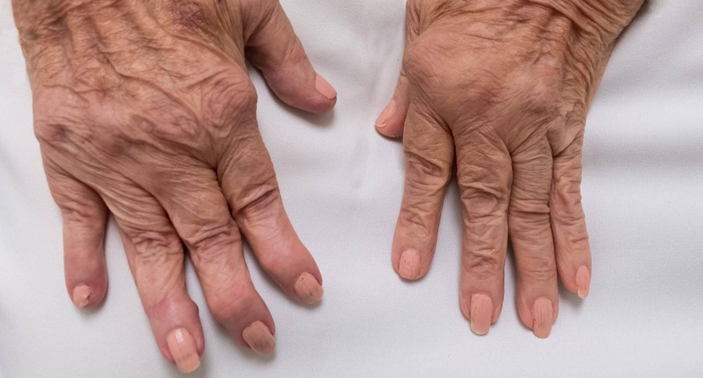 Reumatoidalne zapalenie stawów: objawy i leczenieReumatoidalne zapalenie stawów: objawy i leczenie