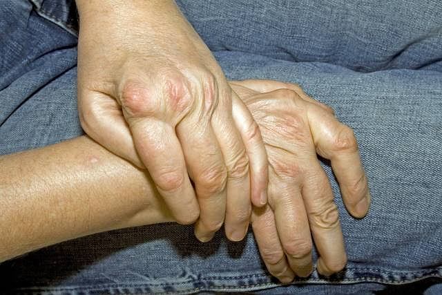 Reumatoidalne zapalenie stawów: objawy i leczenie Reumatoidalne zapalenie stawów: objawy i leczenie