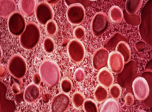 Hemochromatoza: objawy i leczenie Hemochromatoza: objawy i leczenie